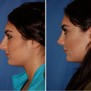 blog logo of nose job bellevue